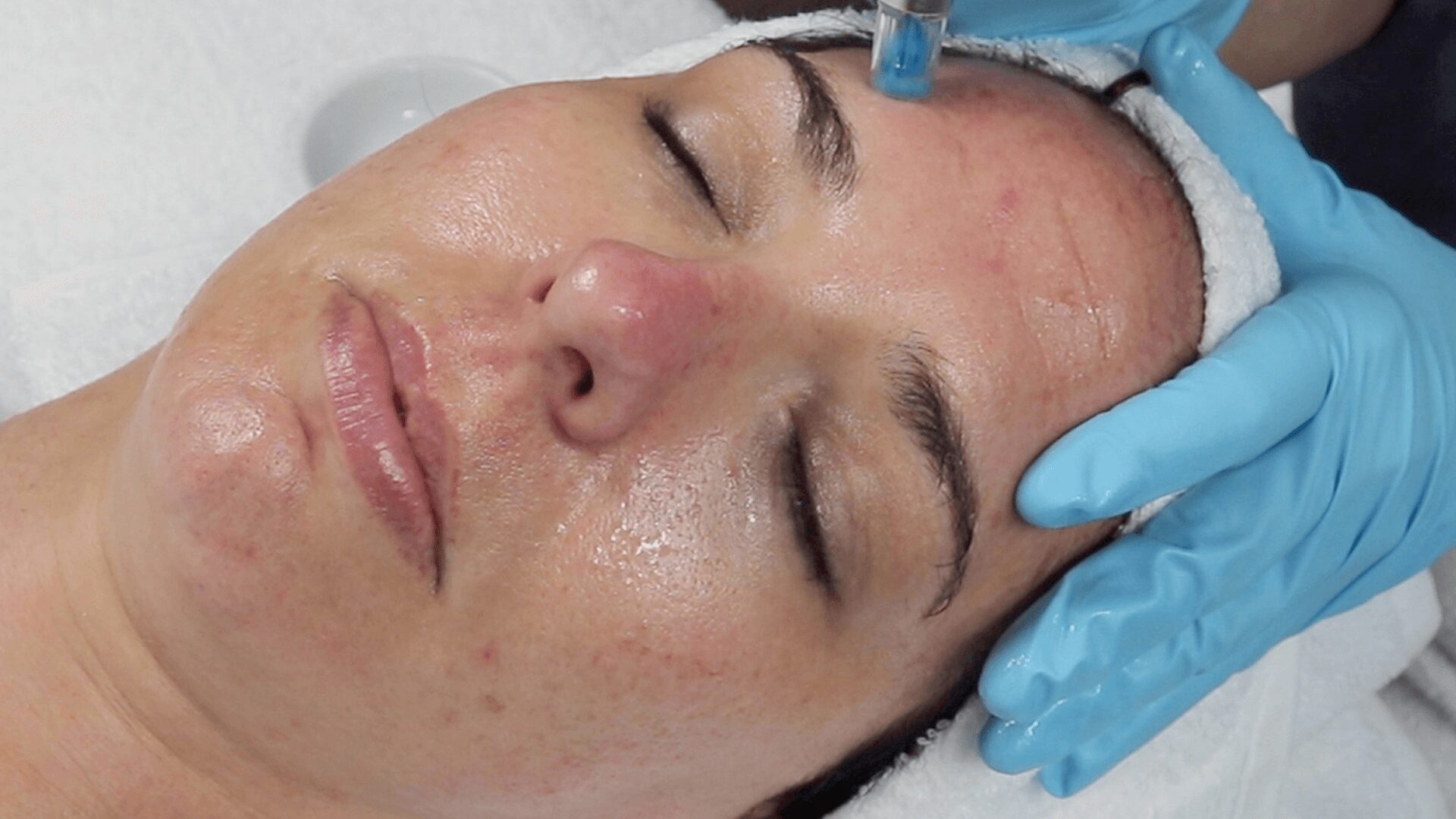 Close-up of facial treatment being applied with a blue tool.
