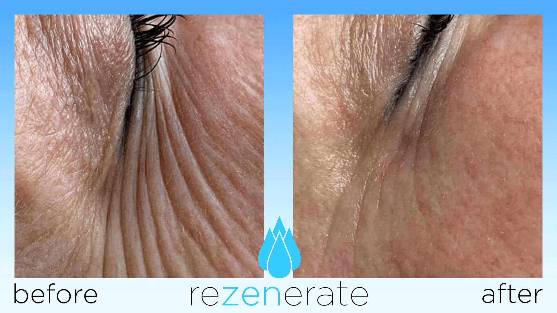 Before and after image showing reduced eye wrinkles with Rezgenerate product.