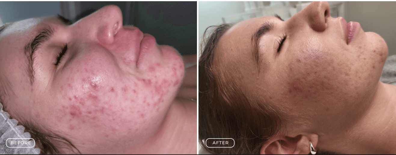 Before and after images showing significant acne improvement on a person's cheek.