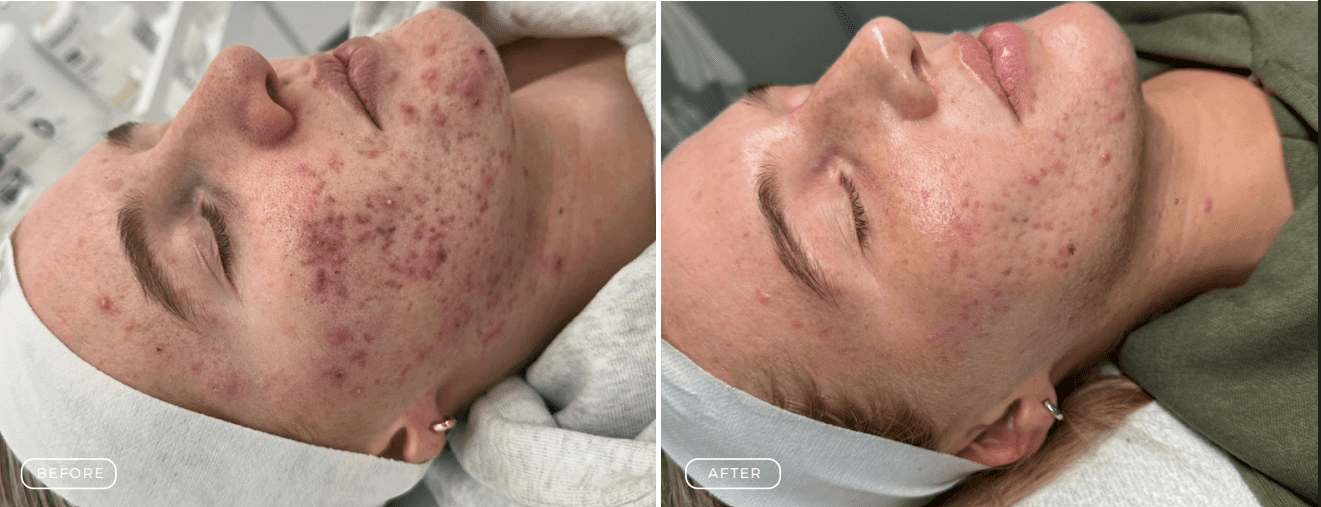 Before and after photos showing significant improvement in facial acne.