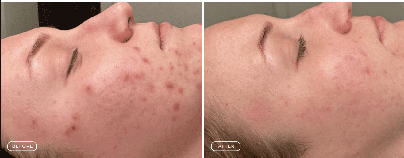 Before and after photos showing significant acne improvement.