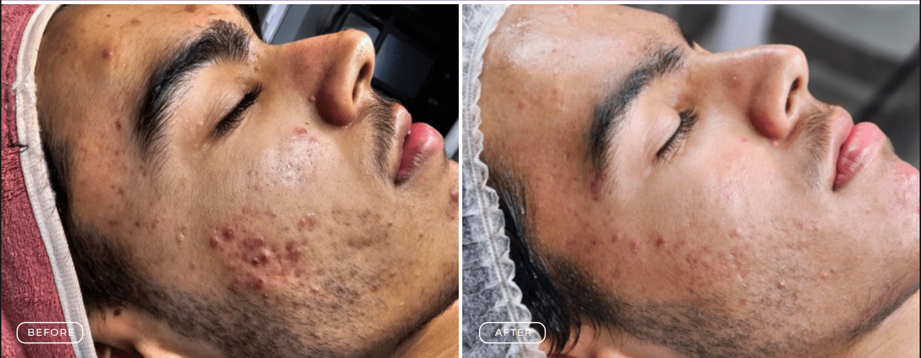 Before and after acne treatment showing significant skin improvement.