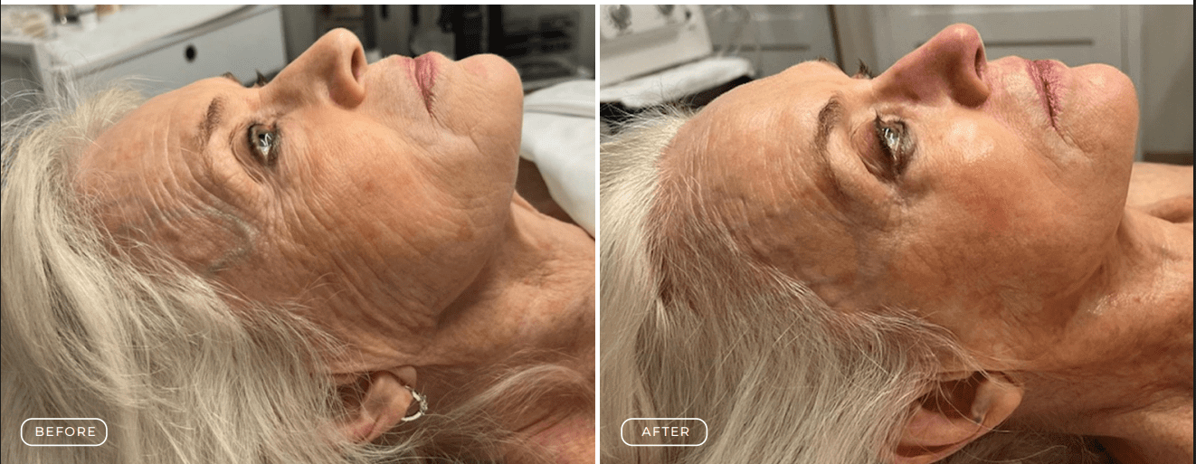 Before and after images showing reduced neck wrinkles.