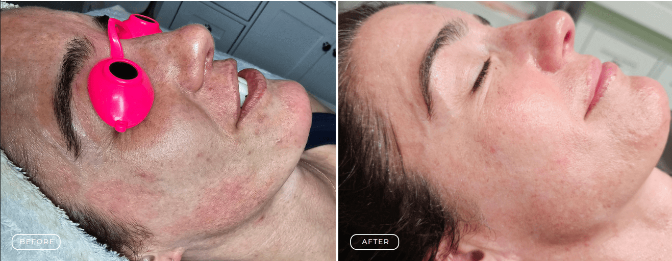 Before and after images of skin treatment showing reduced acne and smoother skin.