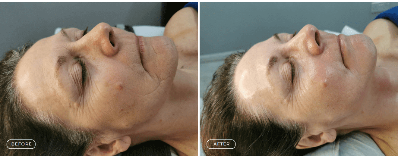Before and after images showing facial hair restoration results.