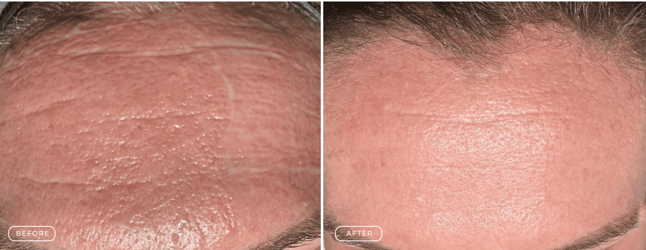 Before and after images showing improved forehead skin texture and reduced wrinkles.